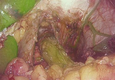 Intraoperative assessment of anastomotic blood supply using indocyanine green fluorescence imaging following esophagojejunostomy or esophagogastrostomy for gastric cancer